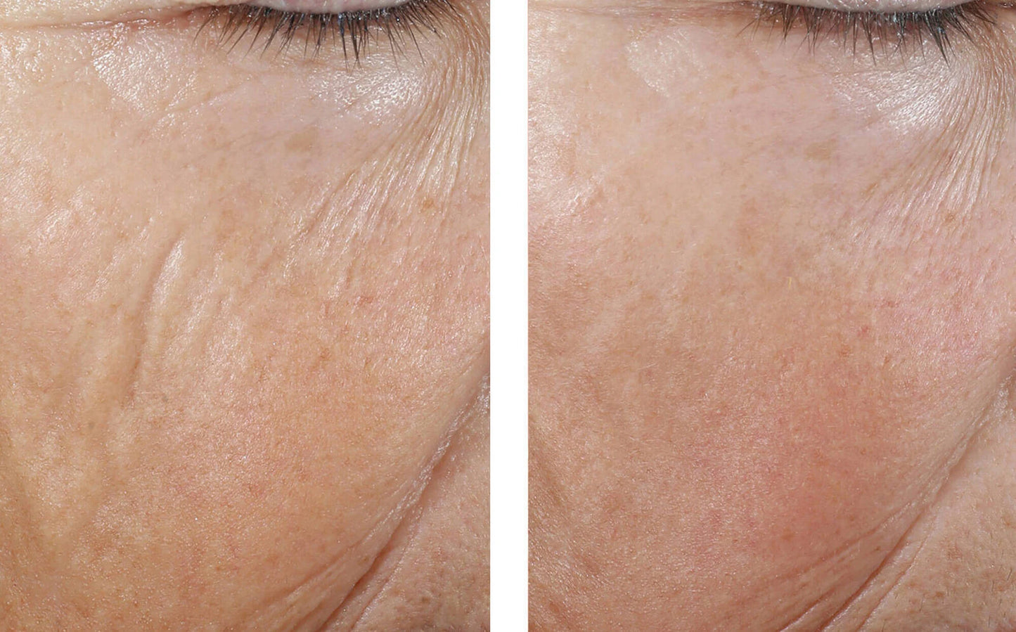 INTERFUSE INTENSIVE TREATMENT LINES 15ML $165