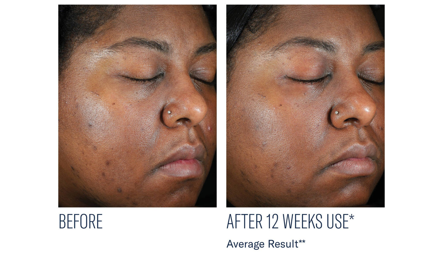 EVEN INTENSIVE SKIN TONE CORRECTING SERUM 50ML $245