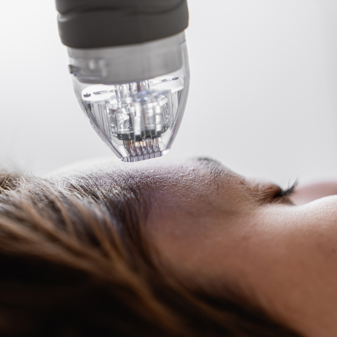 Micro Needling With Rf POTENZA RF MICRO-NEEDLING – Skingoodies Australia