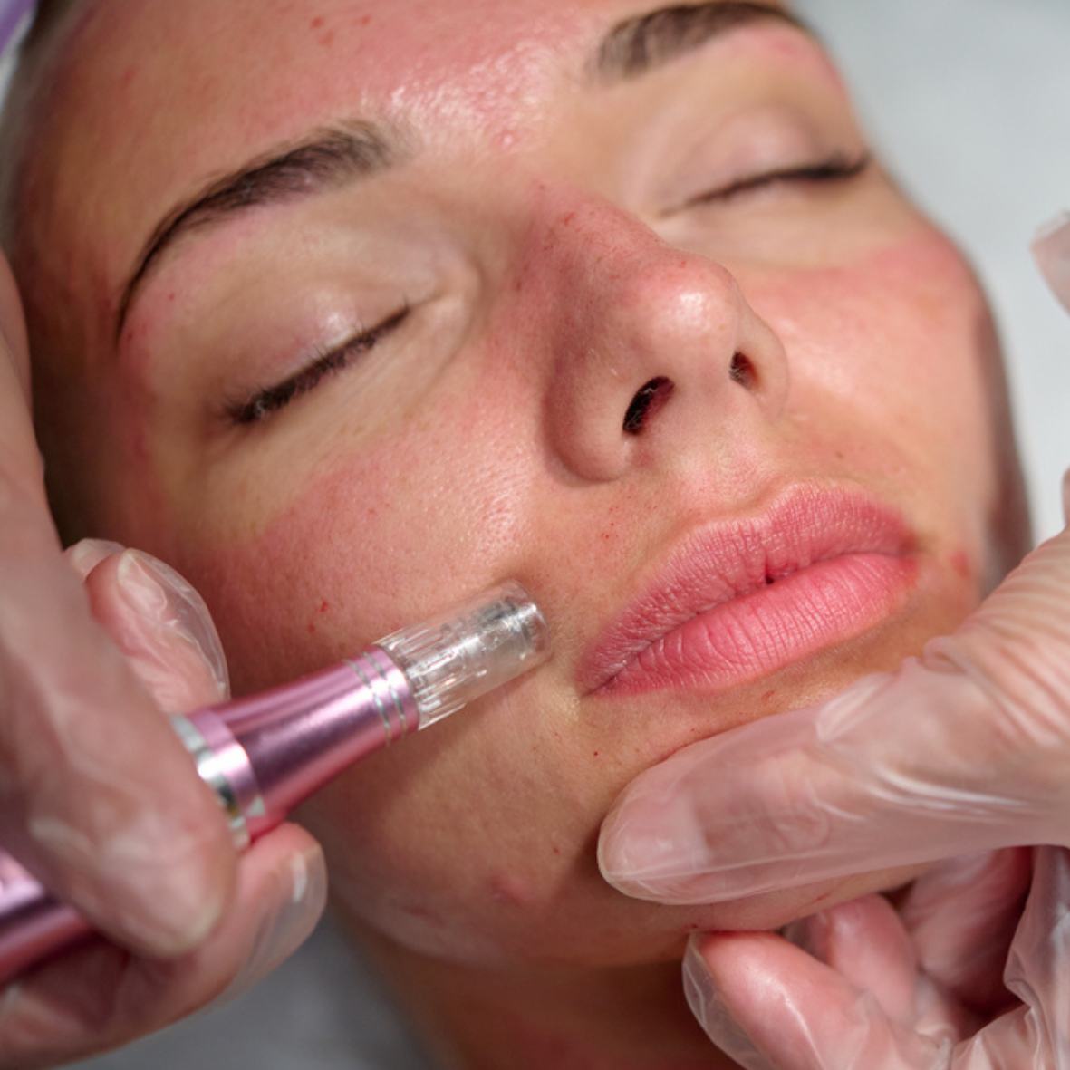 SKIN-NEEDLING