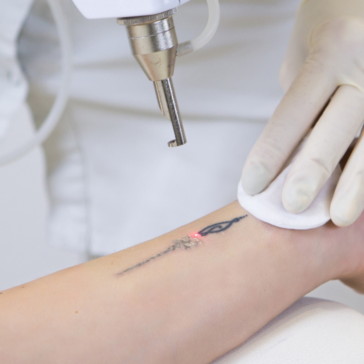 Laser Tattoo Removal Treatment in Kirribilli and Tamworth | Skingoodies  Australia