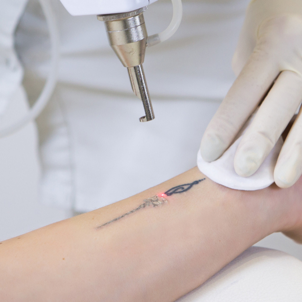 Westend Laser Clinic Aberdeen | Laser Tattoo Removal Aberdeen